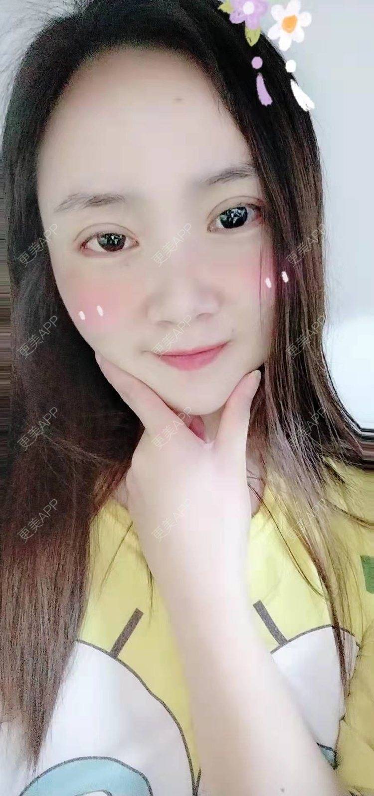 更美 - 更美用户222hTxLwTH的自体脂肪丰卧蚕经验 | 上海 | 自体脂肪丰卧蚕