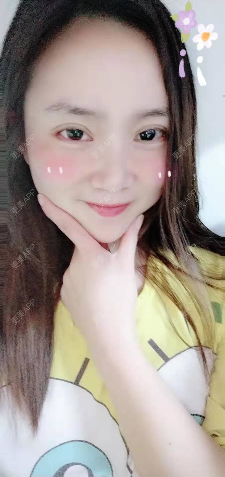 更美 - 更美用户222hTxLwTH的自体脂肪丰卧蚕经验 | 上海 | 自体脂肪丰卧蚕