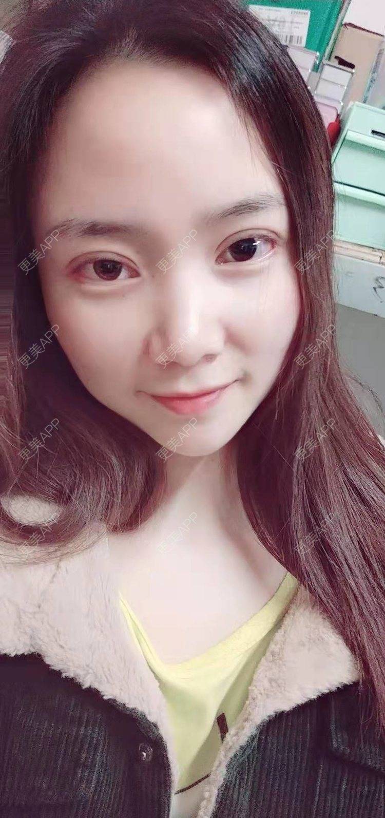 更美 - 更美用户222hTxLwTH的自体脂肪丰卧蚕经验 | 上海 | 自体脂肪丰卧蚕