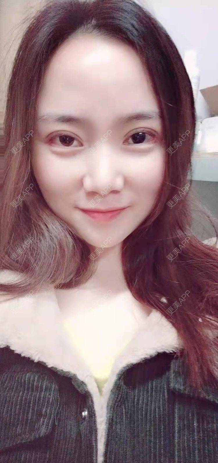 更美 - 更美用户222hTxLwTH的自体脂肪丰卧蚕经验 | 上海 | 自体脂肪丰卧蚕
