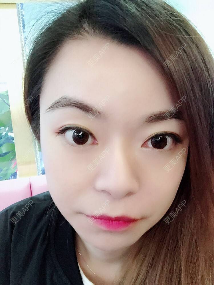 更美 - 冬天里的巧乐兹的内切去眼袋经验 | 上海 | 内切去眼袋 | 视频日记