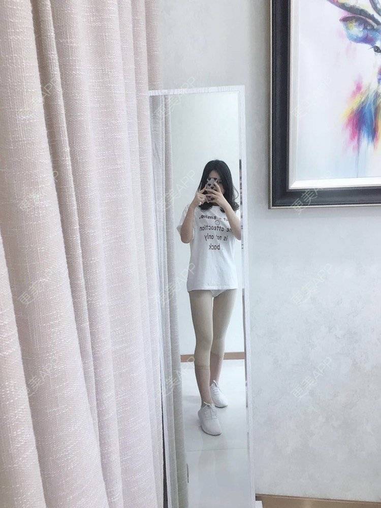 更美 - 更美用户CQFZ0nNp0z的臀部经验 | 自体脂肪丰臀 | 胶原蛋白丰臀 | 假体丰臀 | 吸脂塑臀 | 腰腹吸脂 | 吸脂瘦大腿 | 手臂吸脂