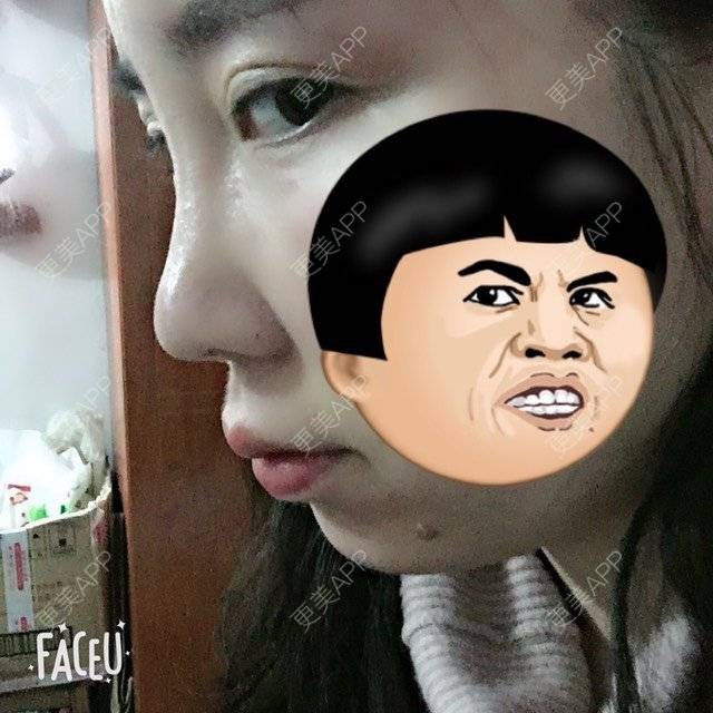 更美 - 付昀柯的鼻部硅胶假体取出经验 | 郑州 | 鼻部硅胶假体取出