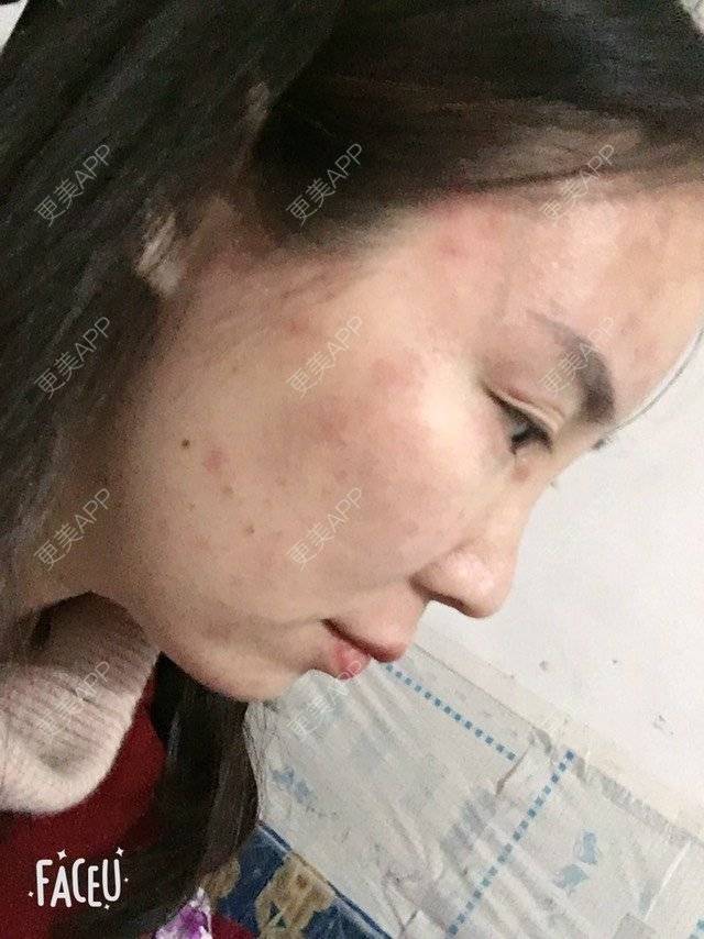 更美 - 付昀柯的鼻部硅胶假体取出经验 | 郑州 | 鼻部硅胶假体取出