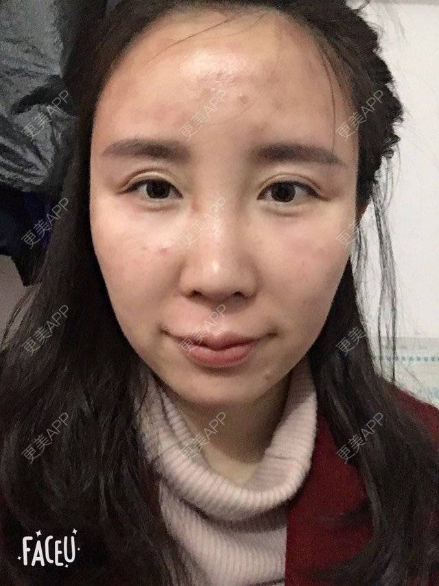 更美 - 付昀柯的鼻部硅胶假体取出经验 | 郑州 | 鼻部硅胶假体取出