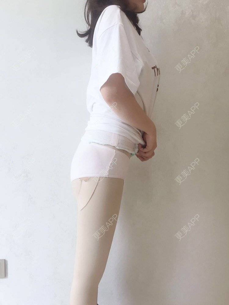 更美 - 更美用户CQFZ0nNp0z的臀部经验 | 自体脂肪丰臀 | 胶原蛋白丰臀 | 假体丰臀 | 吸脂塑臀 | 腰腹吸脂 | 吸脂瘦大腿 | 手臂吸脂