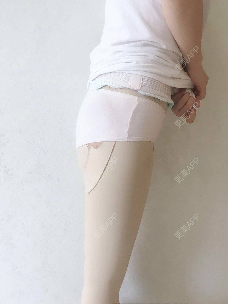 更美 - 更美用户CQFZ0nNp0z的臀部经验 | 自体脂肪丰臀 | 胶原蛋白丰臀 | 假体丰臀 | 吸脂塑臀 | 腰腹吸脂 | 吸脂瘦大腿 | 手臂吸脂