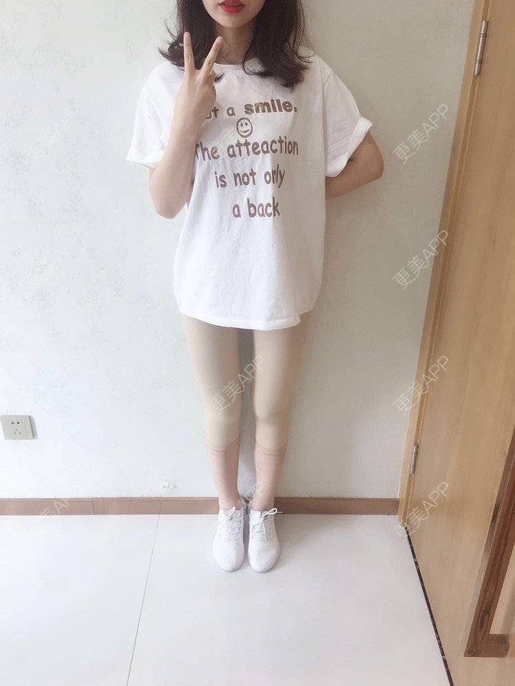 更美 - 更美用户CQFZ0nNp0z的臀部经验 | 自体脂肪丰臀 | 胶原蛋白丰臀 | 假体丰臀 | 吸脂塑臀 | 腰腹吸脂 | 吸脂瘦大腿 | 手臂吸脂