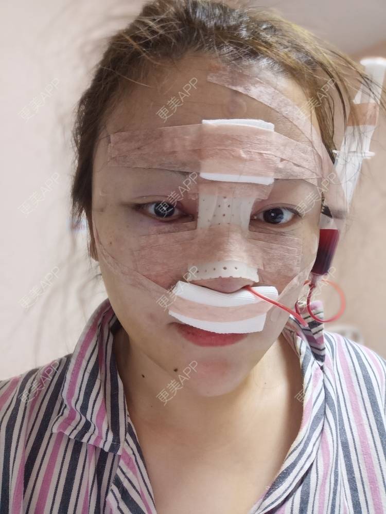 更美 - 💋Lavender💋关Sir💋的鼻部多项经验 | 鼻部膨体假体取出 | 自体脂肪垫鼻基底 | 鼻部多项 | 鼻小柱延长 | 朝天鼻矫正 | 杭州