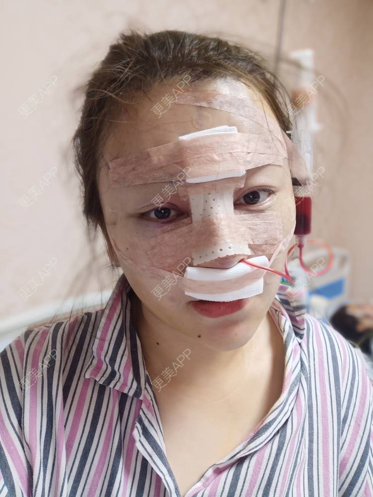 更美 - 💋Lavender💋关Sir💋的鼻部多项经验 | 鼻部膨体假体取出 | 自体脂肪垫鼻基底 | 鼻部多项 | 鼻小柱延长 | 朝天鼻矫正 | 杭州