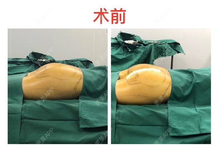 醉忆春寒蚜的假体丰臀日记