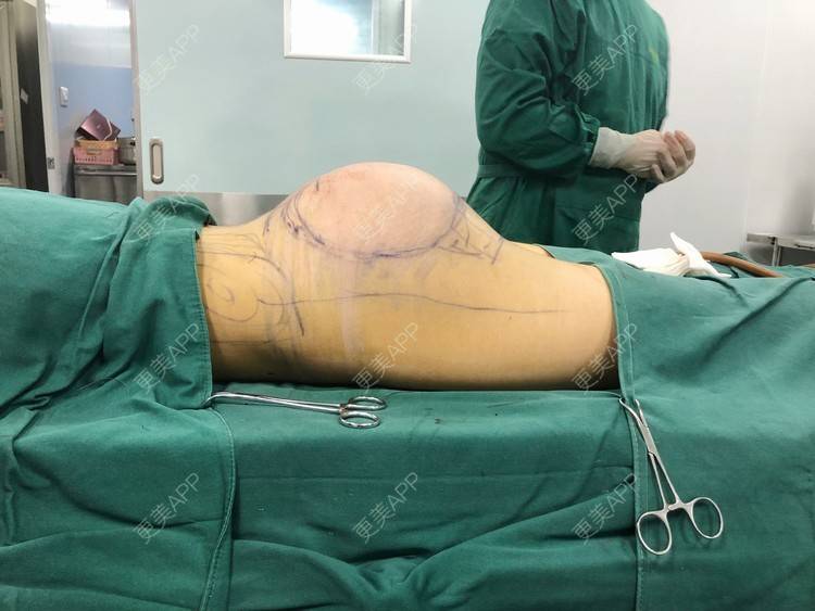 醉忆春寒蚜的假体丰臀日记