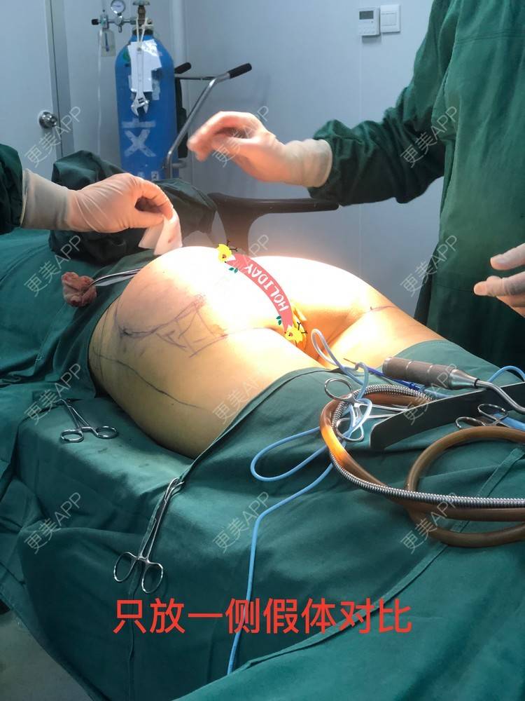 醉忆春寒蚜的假体丰臀日记