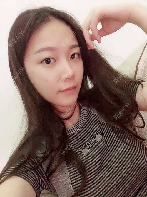 更美 - 更美用户XvsIPyMlco的吸脂瘦脸经验 | 天津 | 吸脂瘦脸