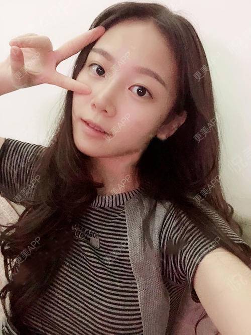 更美 - 更美用户XvsIPyMlco的吸脂瘦脸经验 | 天津 | 吸脂瘦脸