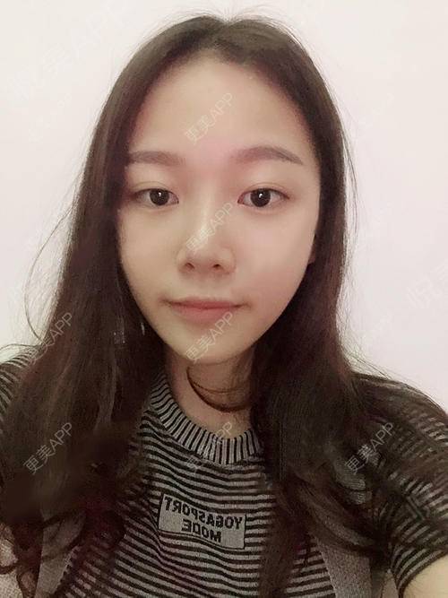 更美 - 更美用户XvsIPyMlco的吸脂瘦脸经验 | 天津 | 吸脂瘦脸