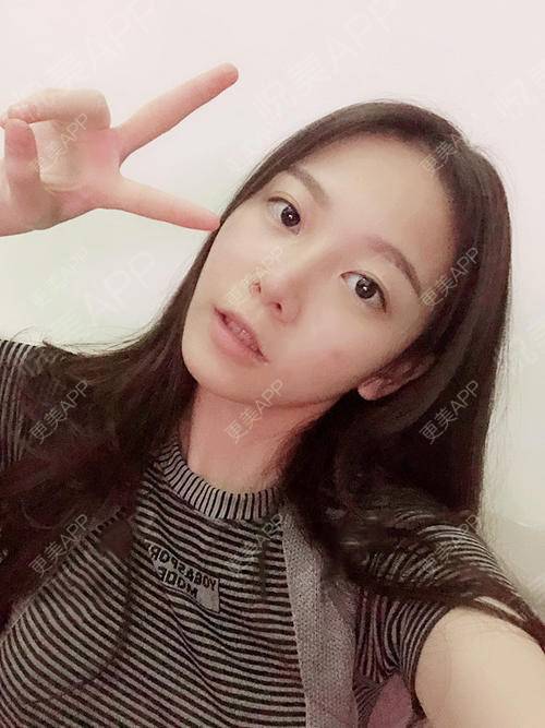 更美 - 更美用户XvsIPyMlco的吸脂瘦脸经验 | 天津 | 吸脂瘦脸