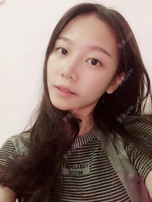 更美 - 更美用户XvsIPyMlco的吸脂瘦脸经验 | 天津 | 吸脂瘦脸