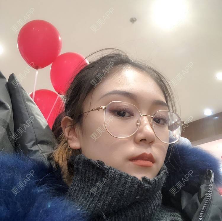 更美 - 黄豆豆呀～的自体脂肪丰太阳穴经验 | 自体脂肪丰苹果肌 | 自体脂肪丰面颊 | 自体脂肪丰额头 | 自体脂肪丰太阳穴 | 自体脂肪填充泪沟 | 温州 | 自体脂肪全面部填充 | 自体脂肪面部填充