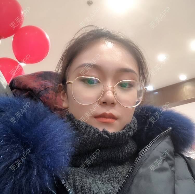 更美 - 黄豆豆呀～的自体脂肪丰太阳穴经验 | 自体脂肪丰苹果肌 | 自体脂肪丰面颊 | 自体脂肪丰额头 | 自体脂肪丰太阳穴 | 自体脂肪填充泪沟 | 温州 | 自体脂肪全面部填充 | 自体脂肪面部填充