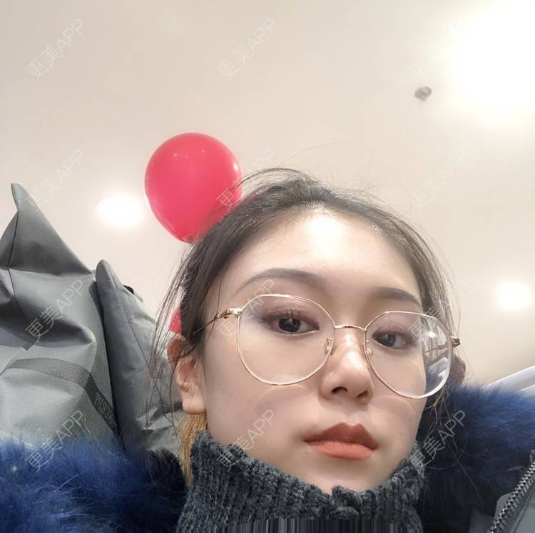 更美 - 黄豆豆呀～的自体脂肪丰太阳穴经验 | 自体脂肪丰苹果肌 | 自体脂肪丰面颊 | 自体脂肪丰额头 | 自体脂肪丰太阳穴 | 自体脂肪填充泪沟 | 温州 | 自体脂肪全面部填充 | 自体脂肪面部填充
