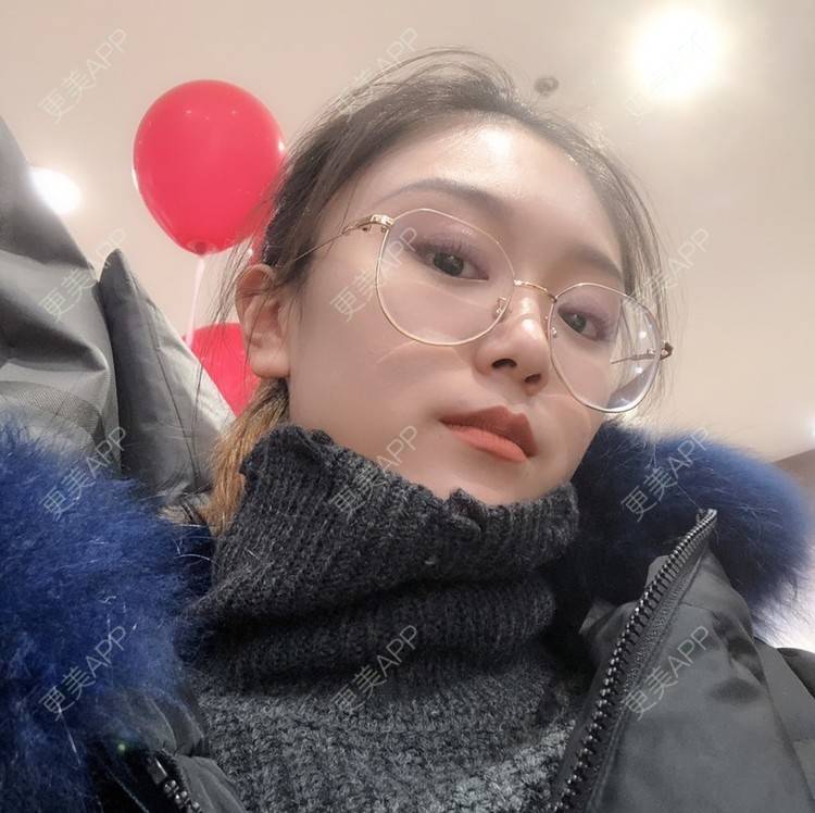 更美 - 黄豆豆呀～的自体脂肪丰太阳穴经验 | 自体脂肪丰苹果肌 | 自体脂肪丰面颊 | 自体脂肪丰额头 | 自体脂肪丰太阳穴 | 自体脂肪填充泪沟 | 温州 | 自体脂肪全面部填充 | 自体脂肪面部填充