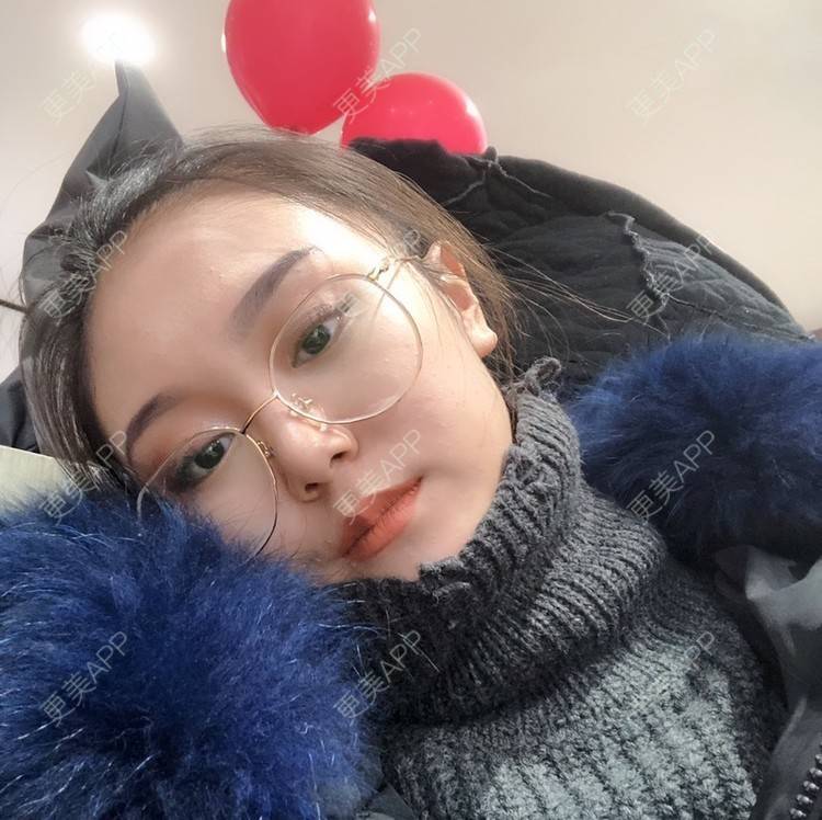 更美 - 黄豆豆呀～的自体脂肪丰太阳穴经验 | 自体脂肪丰苹果肌 | 自体脂肪丰面颊 | 自体脂肪丰额头 | 自体脂肪丰太阳穴 | 自体脂肪填充泪沟 | 温州 | 自体脂肪全面部填充 | 自体脂肪面部填充