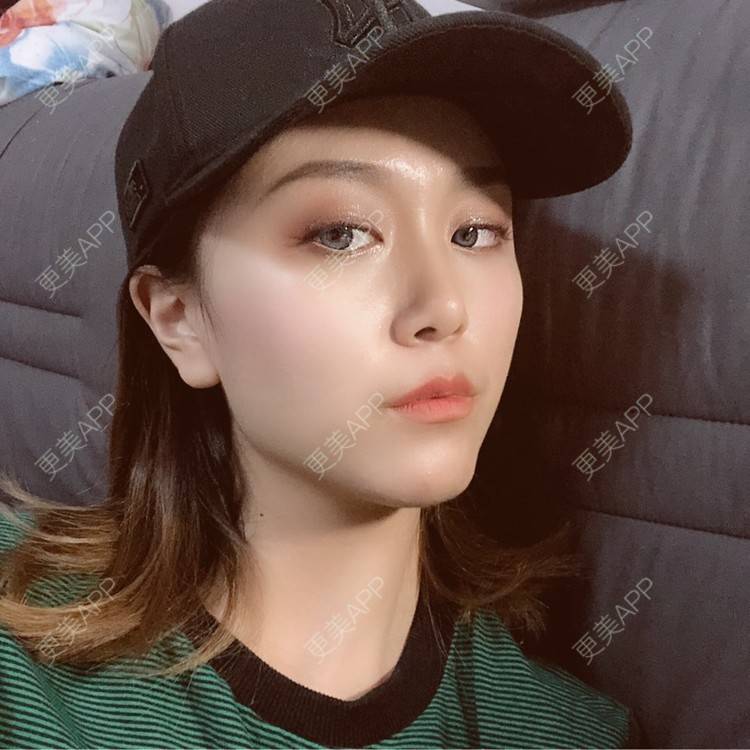 更美 - 黄豆豆呀～的自体脂肪丰太阳穴经验 | 自体脂肪丰苹果肌 | 自体脂肪丰面颊 | 自体脂肪丰额头 | 自体脂肪丰太阳穴 | 自体脂肪垫下巴 | 自体脂肪填充泪沟 | 温州 | 自体脂肪全面部填充 | 自体脂肪面部填充