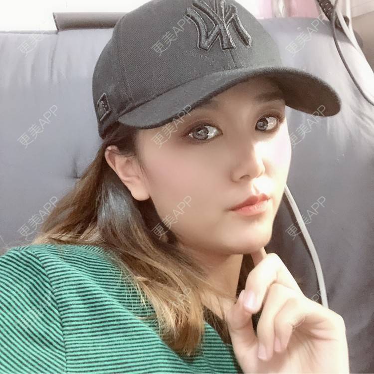 更美 - 黄豆豆呀～的自体脂肪丰太阳穴经验 | 自体脂肪丰苹果肌 | 自体脂肪丰面颊 | 自体脂肪丰额头 | 自体脂肪丰太阳穴 | 自体脂肪垫下巴 | 自体脂肪填充泪沟 | 温州 | 自体脂肪全面部填充 | 自体脂肪面部填充