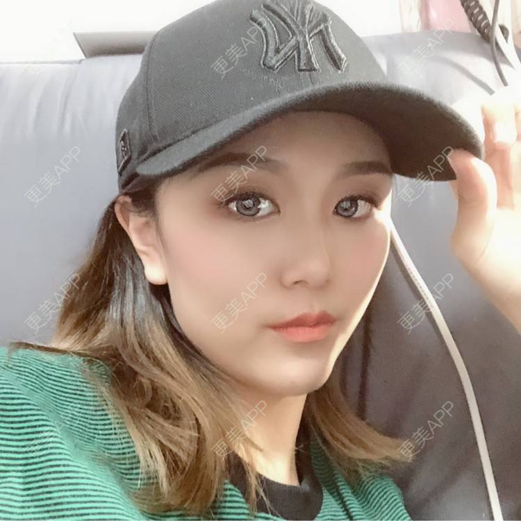 更美 - 黄豆豆呀～的自体脂肪丰太阳穴经验 | 自体脂肪丰苹果肌 | 自体脂肪丰面颊 | 自体脂肪丰额头 | 自体脂肪丰太阳穴 | 自体脂肪垫下巴 | 自体脂肪填充泪沟 | 温州 | 自体脂肪全面部填充 | 自体脂肪面部填充