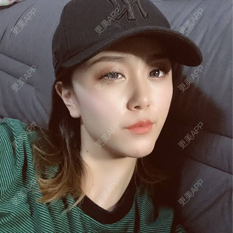 更美 - 黄豆豆呀～的自体脂肪丰太阳穴经验 | 自体脂肪丰苹果肌 | 自体脂肪丰面颊 | 自体脂肪丰额头 | 自体脂肪丰太阳穴 | 自体脂肪垫下巴 | 自体脂肪填充泪沟 | 温州 | 自体脂肪全面部填充 | 自体脂肪面部填充