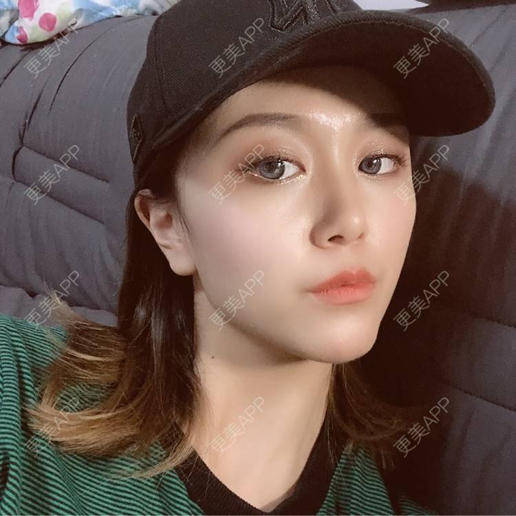 更美 - 黄豆豆呀～的自体脂肪丰太阳穴经验 | 自体脂肪丰苹果肌 | 自体脂肪丰面颊 | 自体脂肪丰额头 | 自体脂肪丰太阳穴 | 自体脂肪垫下巴 | 自体脂肪填充泪沟 | 温州 | 自体脂肪全面部填充 | 自体脂肪面部填充