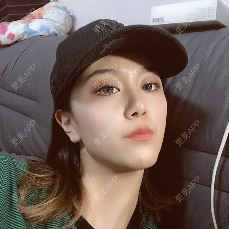 更美 - 黄豆豆呀～的自体脂肪丰太阳穴经验 | 自体脂肪丰苹果肌 | 自体脂肪丰面颊 | 自体脂肪丰额头 | 自体脂肪丰太阳穴 | 自体脂肪垫下巴 | 自体脂肪填充泪沟 | 温州 | 自体脂肪全面部填充 | 自体脂肪面部填充