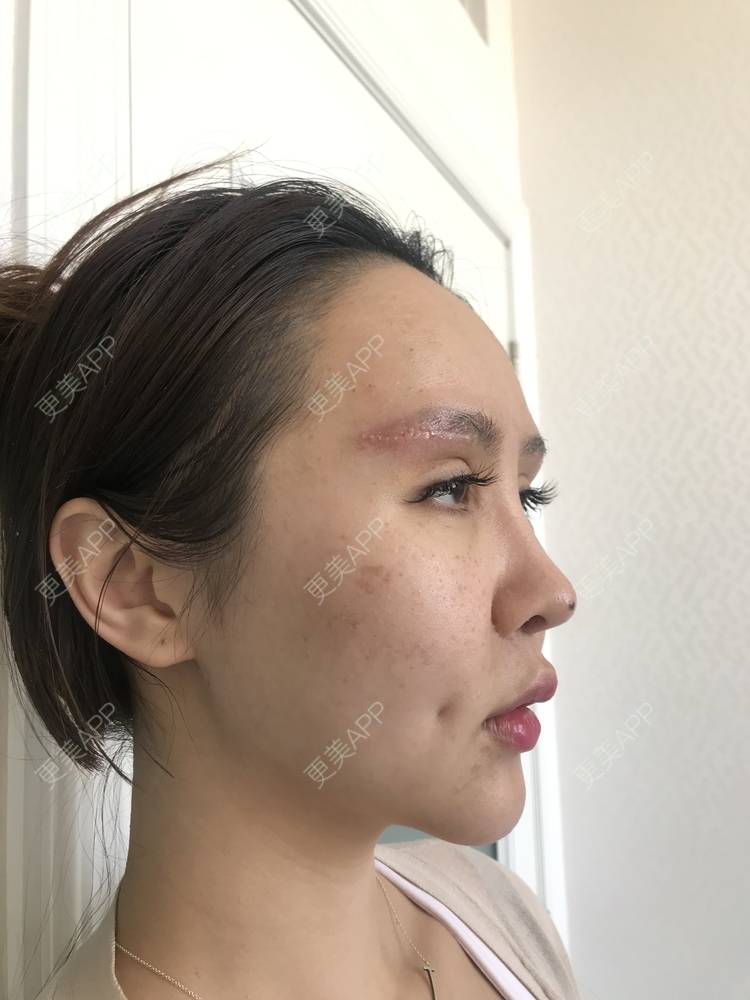 更美用户jsmwr2rnl3的膨体垫眉弓日记