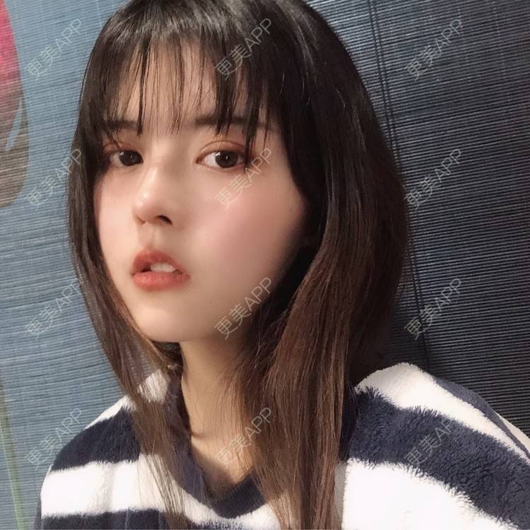 更美 - 酱酱i的自体脂肪丰苹果肌经验 | 自体脂肪面部填充 | 自体脂肪丰苹果肌 | 自体脂肪丰额头 | 自体脂肪丰太阳穴 | 自体脂肪垫下巴 | 自体脂肪填充泪沟 | 自体脂肪丰面颊 | 温州 | 自体脂肪全面部填充
