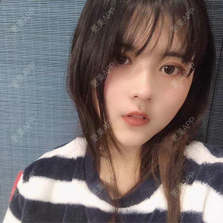 更美 - 酱酱i的自体脂肪丰苹果肌经验 | 自体脂肪面部填充 | 自体脂肪丰苹果肌 | 自体脂肪丰额头 | 自体脂肪丰太阳穴 | 自体脂肪垫下巴 | 自体脂肪填充泪沟 | 自体脂肪丰面颊 | 温州 | 自体脂肪全面部填充