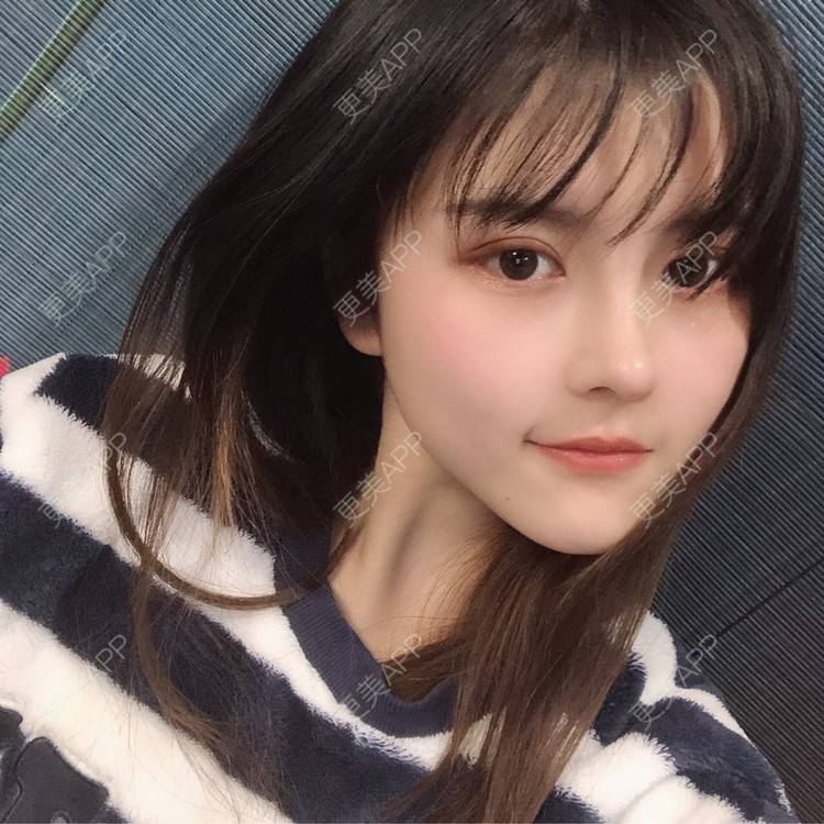 更美 - 酱酱i的自体脂肪丰苹果肌经验 | 自体脂肪面部填充 | 自体脂肪丰苹果肌 | 自体脂肪丰额头 | 自体脂肪丰太阳穴 | 自体脂肪垫下巴 | 自体脂肪填充泪沟 | 自体脂肪丰面颊 | 温州 | 自体脂肪全面部填充