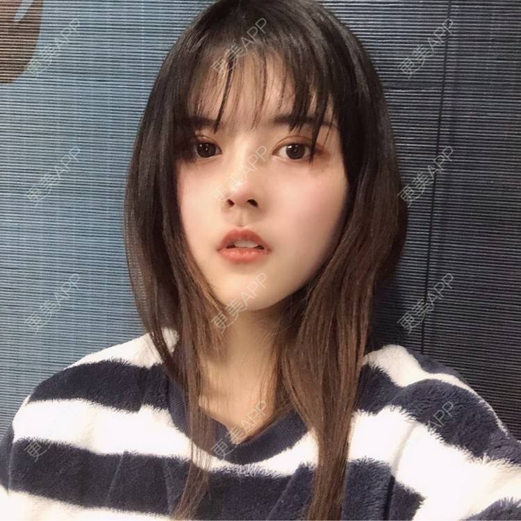 更美 - 酱酱i的自体脂肪丰苹果肌经验 | 自体脂肪面部填充 | 自体脂肪丰苹果肌 | 自体脂肪丰额头 | 自体脂肪丰太阳穴 | 自体脂肪垫下巴 | 自体脂肪填充泪沟 | 自体脂肪丰面颊 | 温州 | 自体脂肪全面部填充