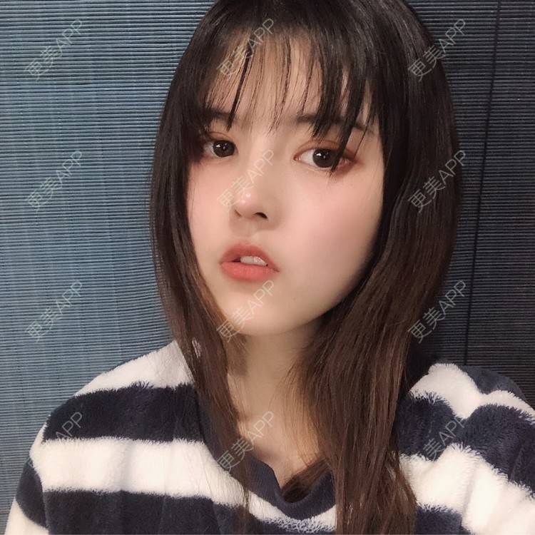 更美 - 酱酱i的自体脂肪丰苹果肌经验 | 自体脂肪面部填充 | 自体脂肪丰苹果肌 | 自体脂肪丰额头 | 自体脂肪丰太阳穴 | 自体脂肪垫下巴 | 自体脂肪填充泪沟 | 自体脂肪丰面颊 | 温州 | 自体脂肪全面部填充