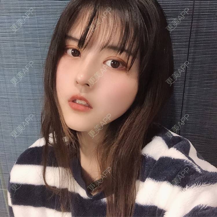 更美 - 酱酱i的自体脂肪丰苹果肌经验 | 自体脂肪面部填充 | 自体脂肪丰苹果肌 | 自体脂肪丰额头 | 自体脂肪丰太阳穴 | 自体脂肪垫下巴 | 自体脂肪填充泪沟 | 自体脂肪丰面颊 | 温州 | 自体脂肪全面部填充