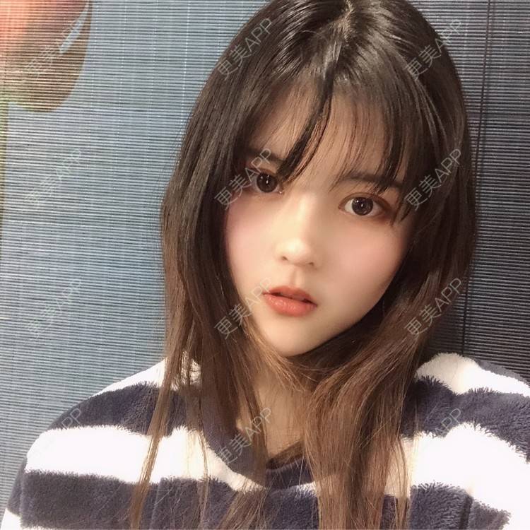 更美 - 酱酱i的自体脂肪丰苹果肌经验 | 自体脂肪面部填充 | 自体脂肪丰苹果肌 | 自体脂肪丰额头 | 自体脂肪丰太阳穴 | 自体脂肪垫下巴 | 自体脂肪填充泪沟 | 自体脂肪丰面颊 | 温州 | 自体脂肪全面部填充