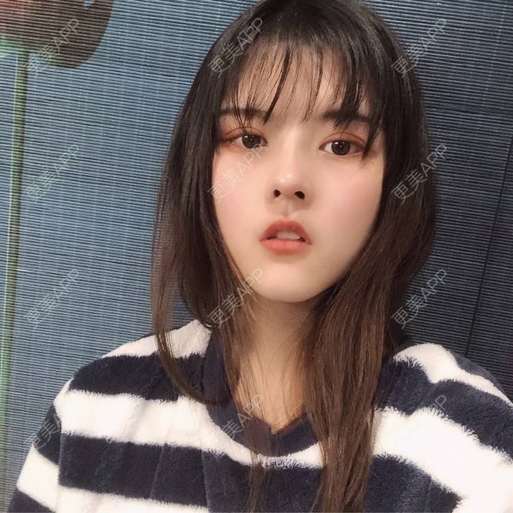 更美 - 酱酱i的自体脂肪丰苹果肌经验 | 自体脂肪面部填充 | 自体脂肪丰苹果肌 | 自体脂肪丰额头 | 自体脂肪丰太阳穴 | 自体脂肪垫下巴 | 自体脂肪填充泪沟 | 自体脂肪丰面颊 | 温州 | 自体脂肪全面部填充