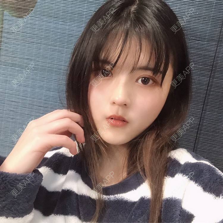 更美 - 酱酱i的自体脂肪丰苹果肌经验 | 自体脂肪面部填充 | 自体脂肪丰苹果肌 | 自体脂肪丰额头 | 自体脂肪丰太阳穴 | 自体脂肪垫下巴 | 自体脂肪填充泪沟 | 自体脂肪丰面颊 | 温州 | 自体脂肪全面部填充