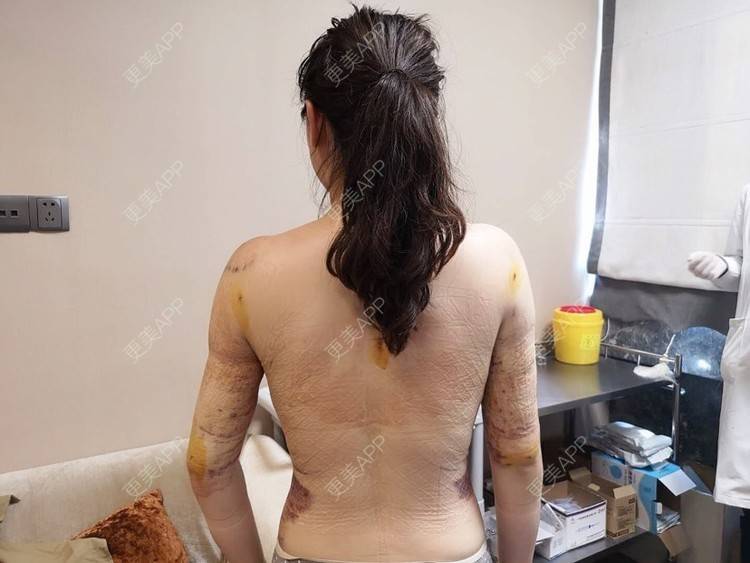 更美用户shyyflhsy2的吸脂日记