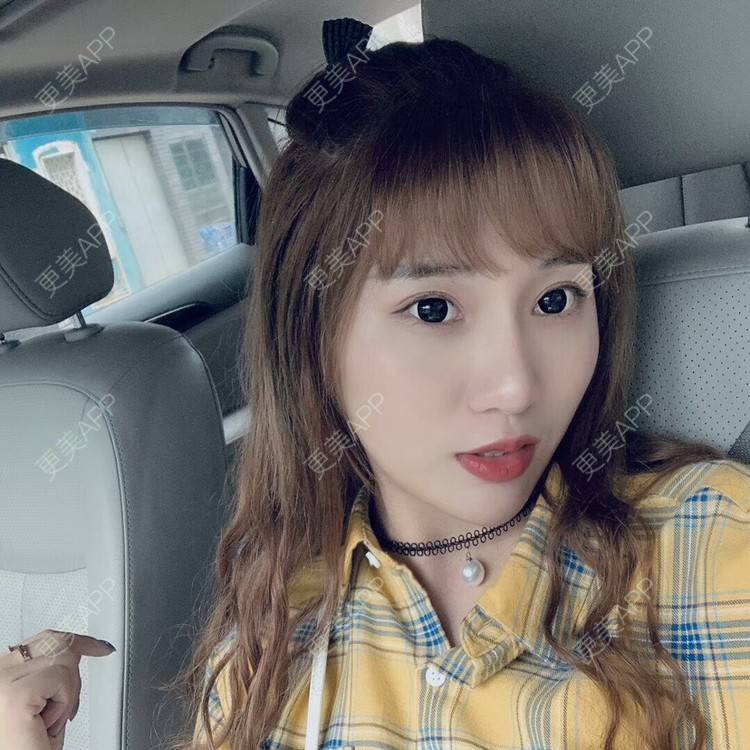 更美 - 我的郭靖的隆鼻经验 | 硅胶隆鼻 | 鼻翼缩小 | 鼻部多项 | 鼻部综合 | 隆鼻 | 自体软骨垫鼻尖 | 温州 | 耳软骨隆鼻