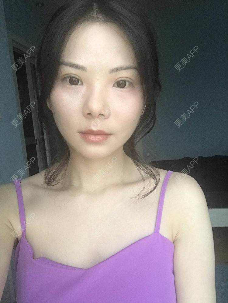 更美 - 弥满遍地的桂花香的颧弓降低经验 | 颧骨颧弓 | 颧骨内推 | 颧骨提高 | 颧弓降低 | 颧骨填充