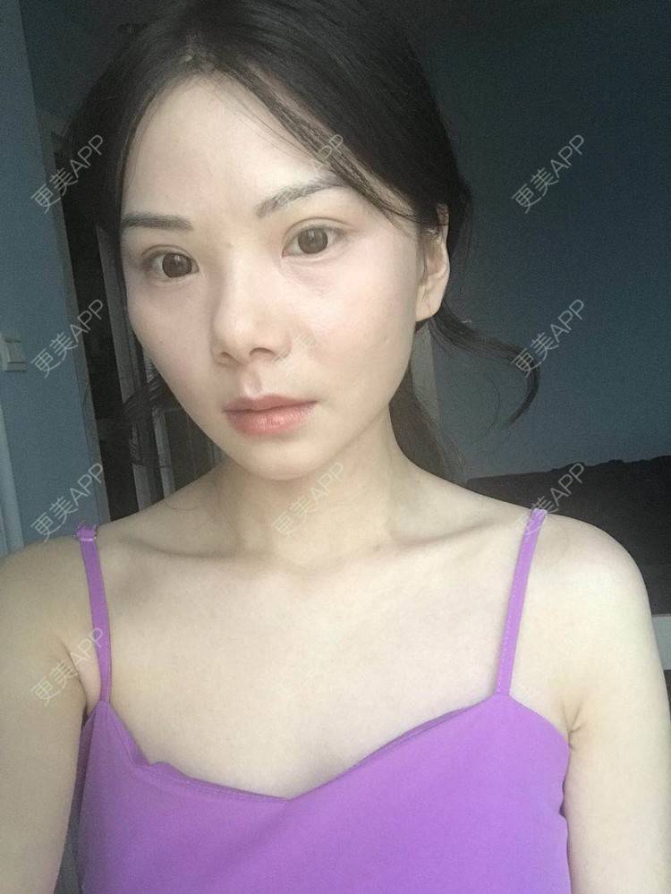 更美 - 弥满遍地的桂花香的颧弓降低经验 | 颧骨颧弓 | 颧骨内推 | 颧骨提高 | 颧弓降低 | 颧骨填充