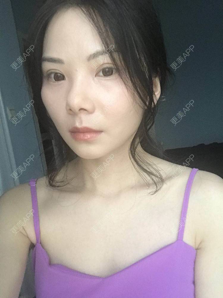 更美 - 弥满遍地的桂花香的颧弓降低经验 | 颧骨颧弓 | 颧骨内推 | 颧骨提高 | 颧弓降低 | 颧骨填充