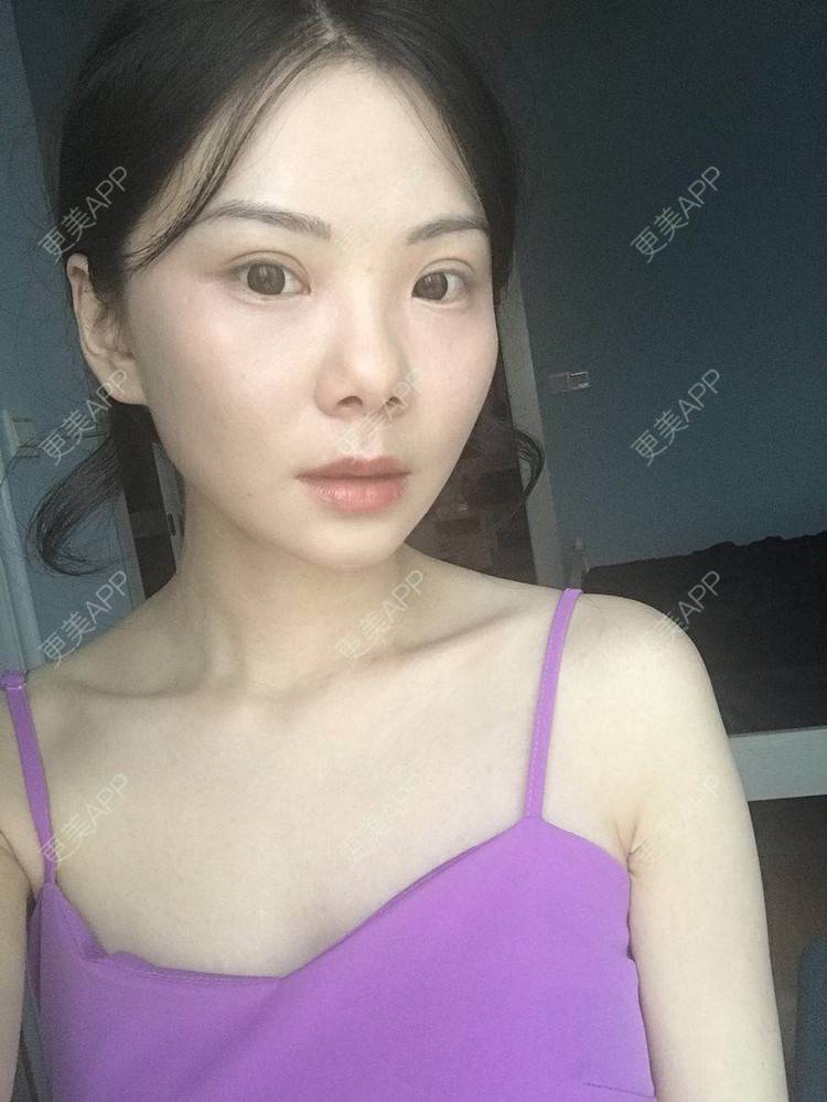 更美 - 弥满遍地的桂花香的颧弓降低经验 | 颧骨颧弓 | 颧骨内推 | 颧骨提高 | 颧弓降低 | 颧骨填充