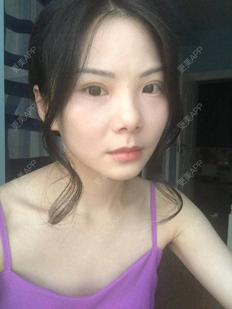 更美 - 弥满遍地的桂花香的颧弓降低经验 | 颧骨颧弓 | 颧骨内推 | 颧骨提高 | 颧弓降低 | 颧骨填充